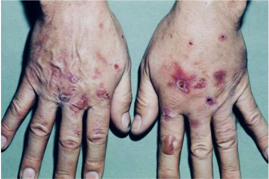 Dorsum of hand showing lesions of various stages surrounded by hyperpigmentation with few lesions showing scabs.