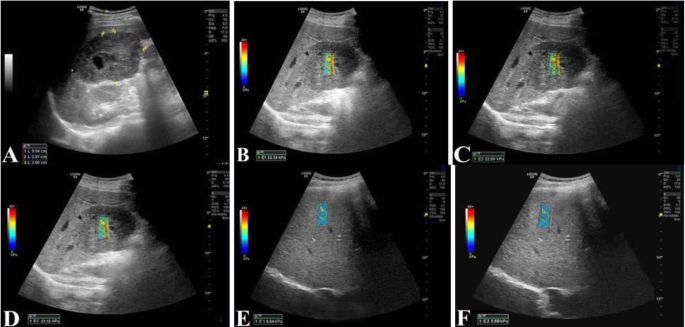Ultrasound Elastography in Characterization of Focal Solid Hepatic Lesion