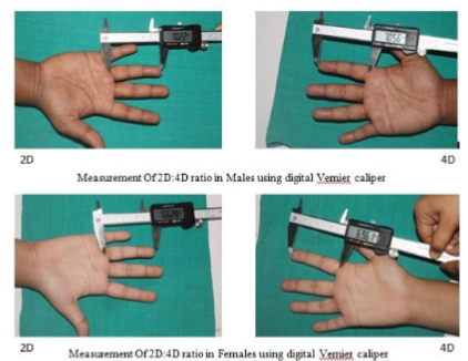 MeasurementOf 2D:4D ratio in males and females using digital Vernier Calipers